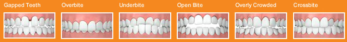 Invisalign can fix the following bite patterns